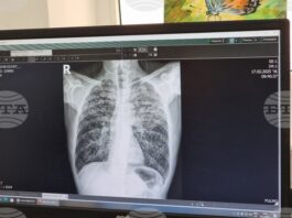 Общо 26 случая на туберкулоза са регистрирани до края на ноември в Пазарджишко