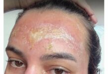 Мнима козметичка обезобрази майка с „билков“ пилинг“, после я заплашва